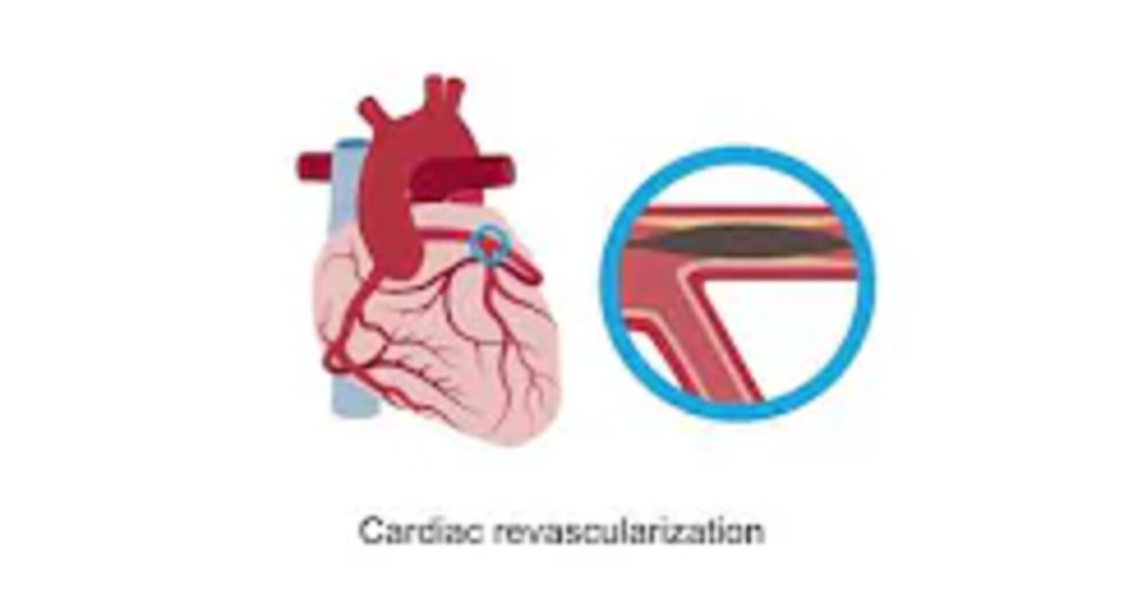 Considering mechanical circulatory support
