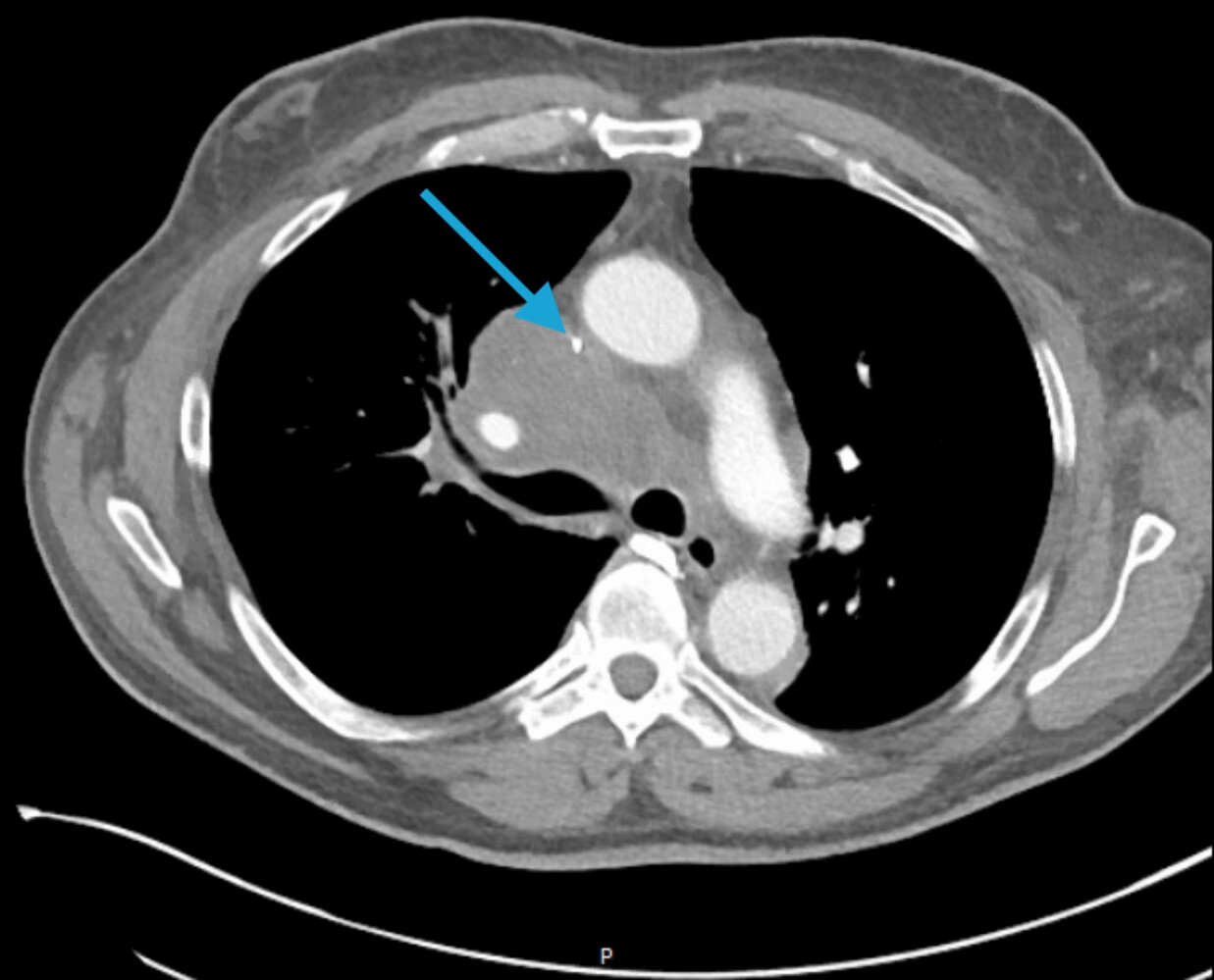 Superior vena cava obstruction