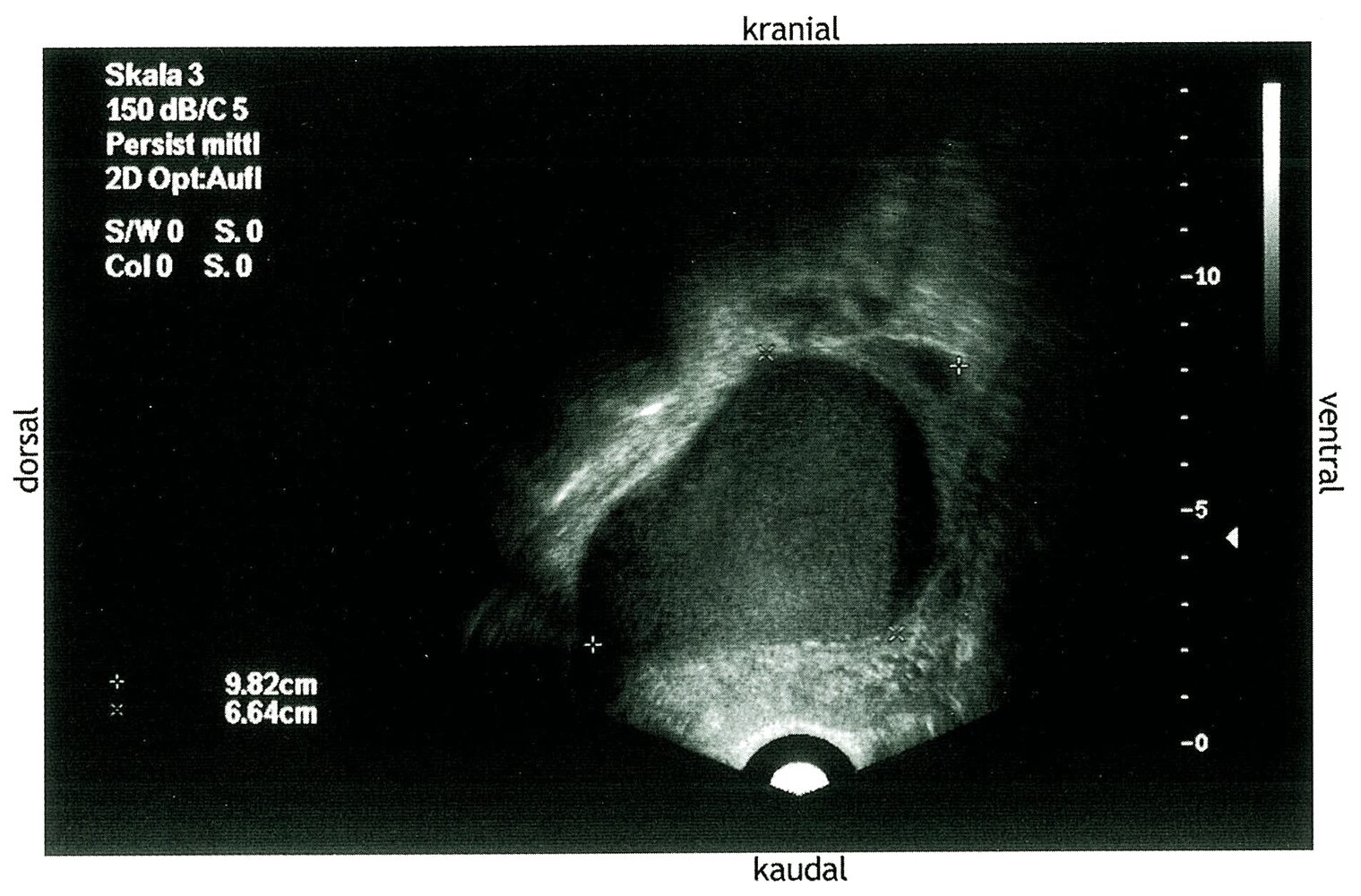 Hemorrhagic ovarian cyst