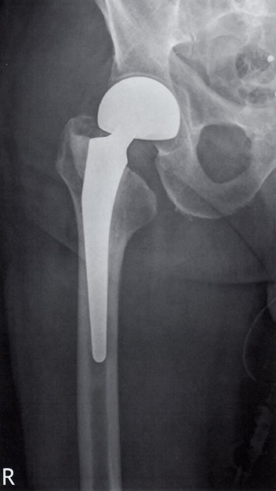 Bipolar right hip prosthesis