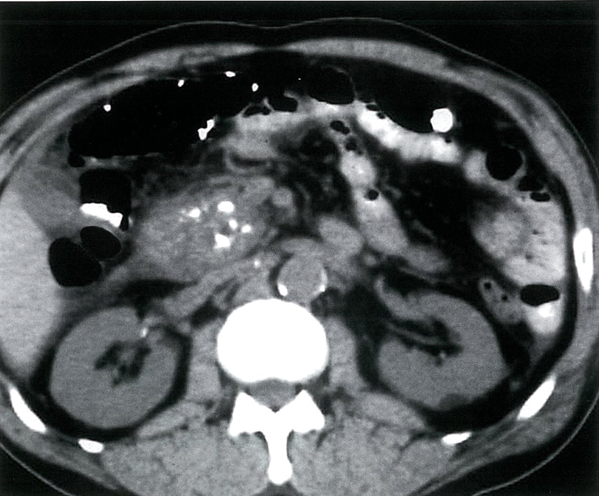 Acute-on-chronic pancreatitis