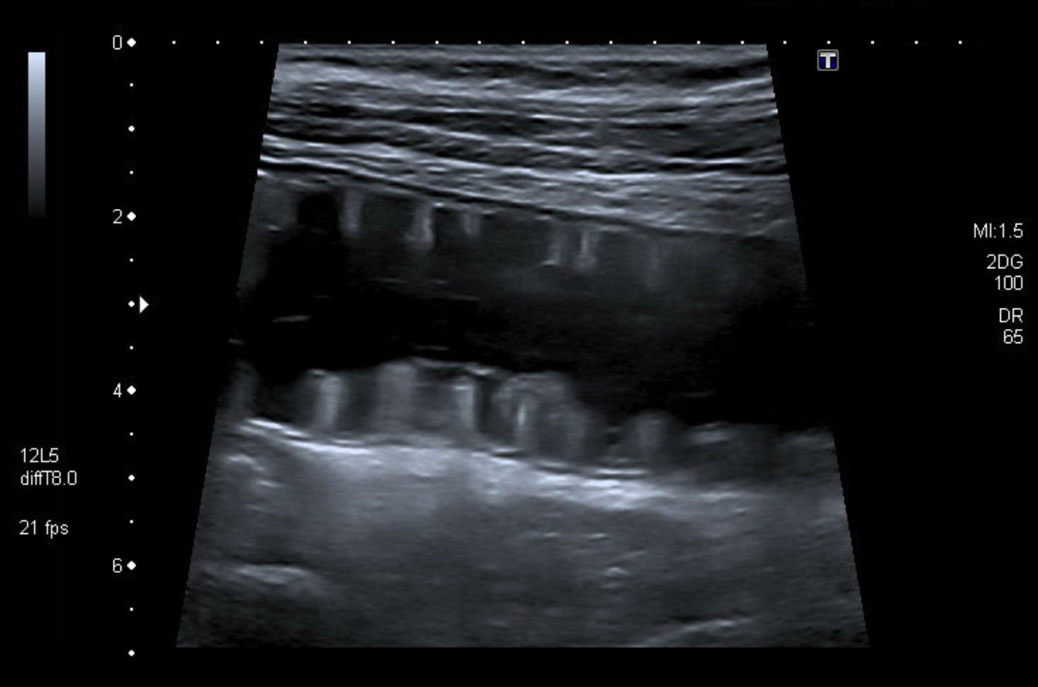 Piano key sign in dilated small bowel