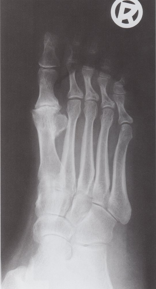 Advanced degenerative arthritis of the great toe metatarsophalangeal joint (2/2)