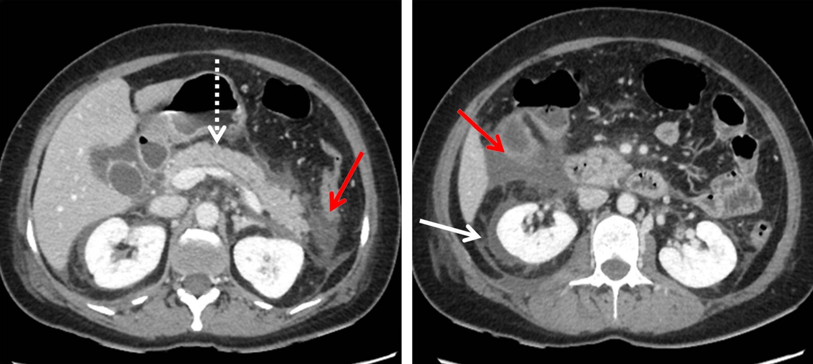 Peripancreatic fluid in acute interstitial pancreatitis
