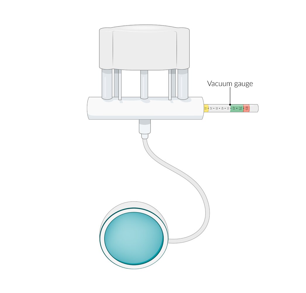 Vacuum extractor