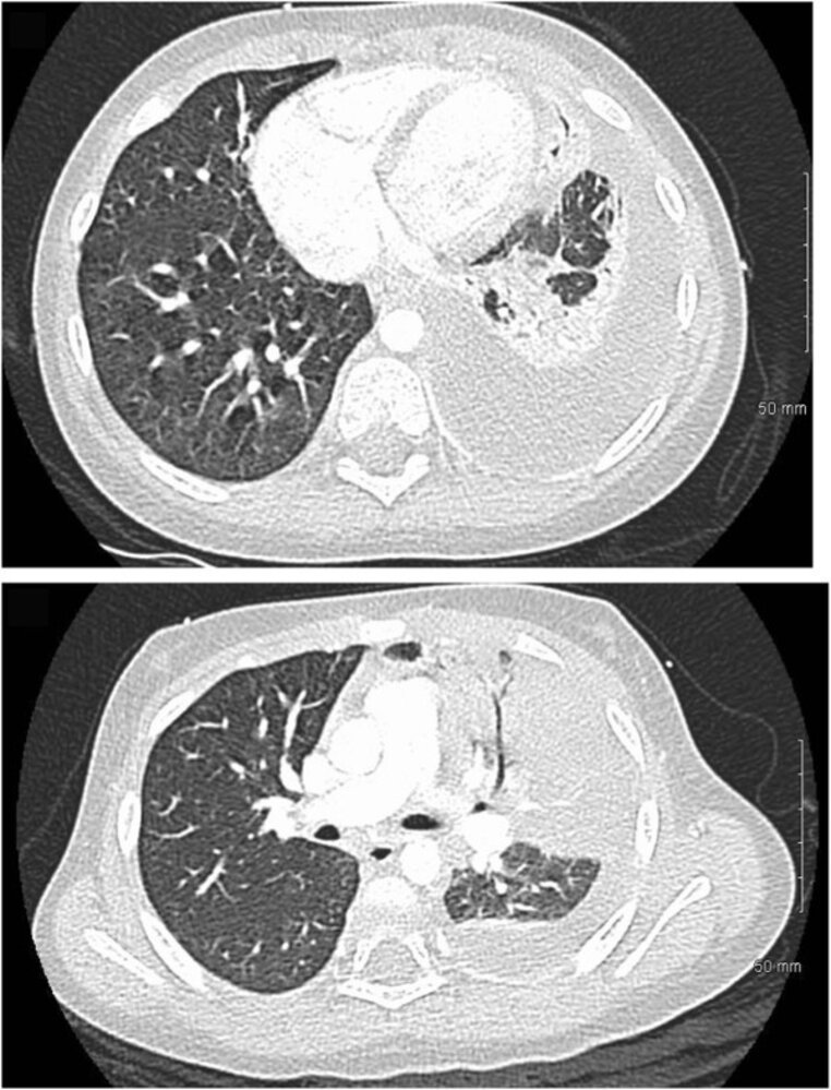 Pneumonia with parapneumonic effusion