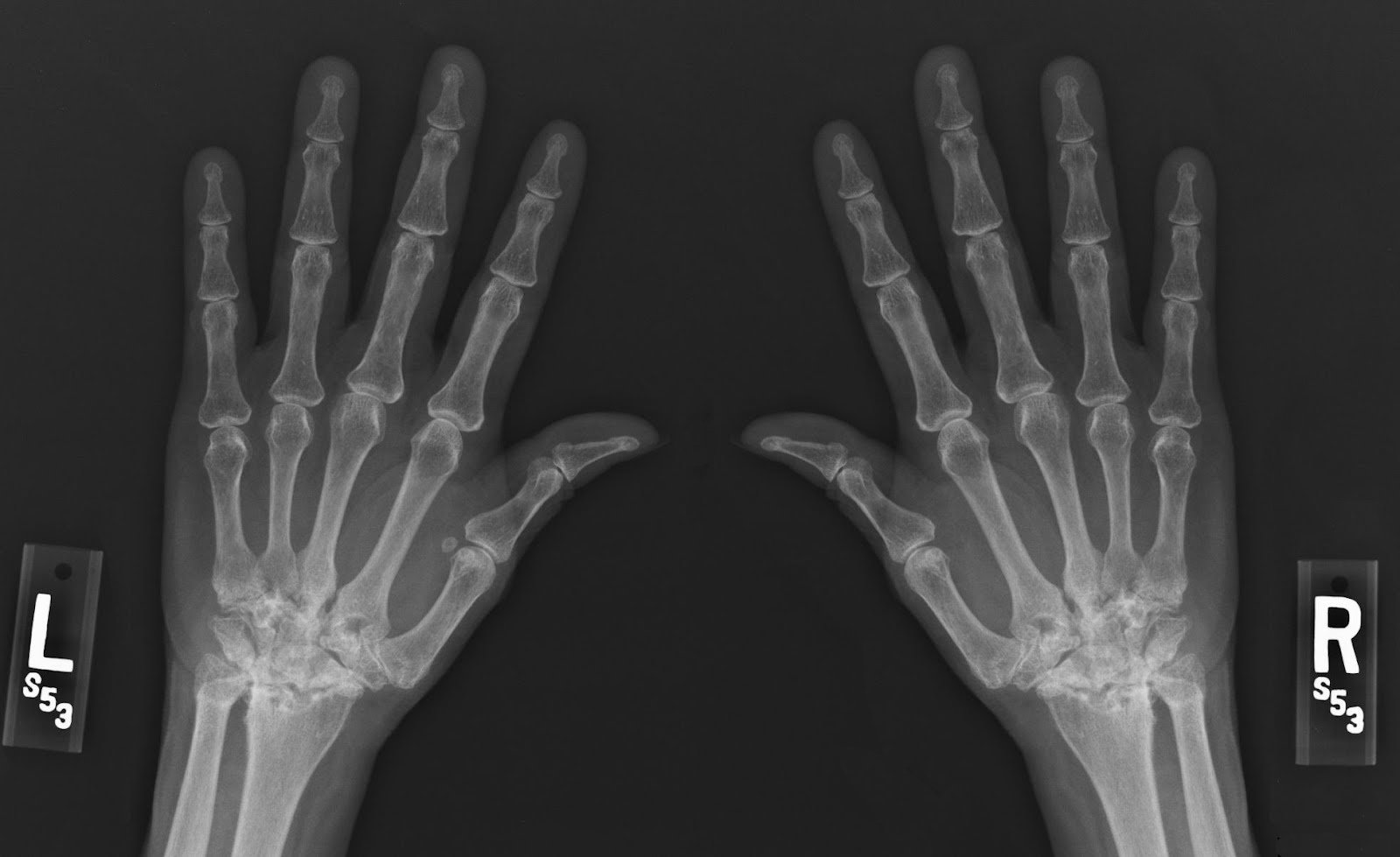Rheumatoid arthritis of the wrist and hand