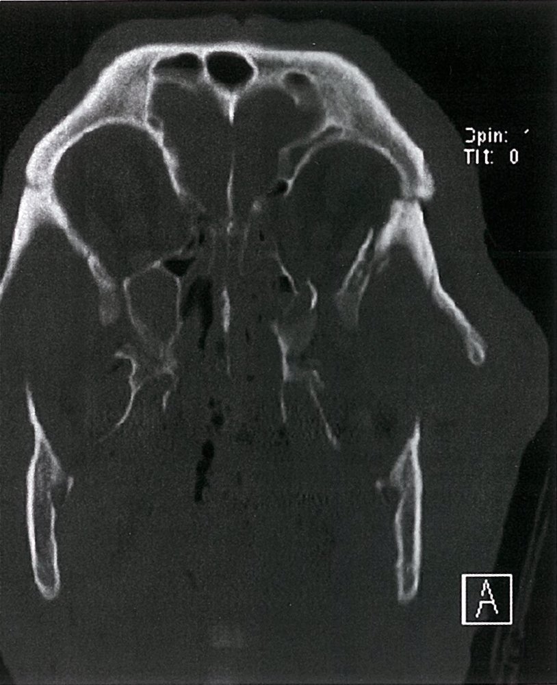 Facial and orbital fractures