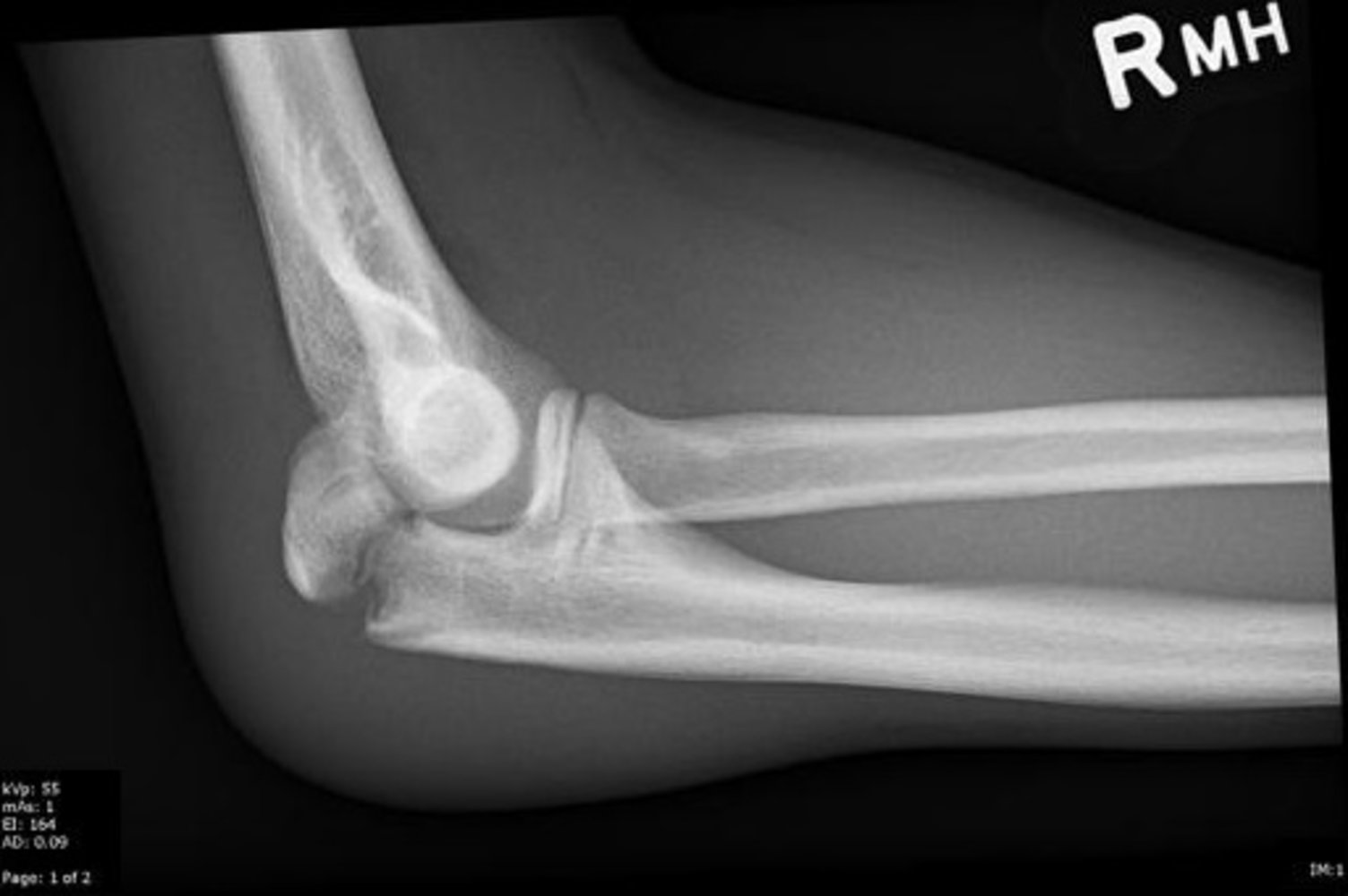 Fracture through olecranon physis