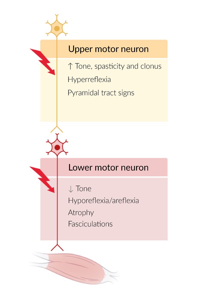 Findings in lower or upper motor neuron damage