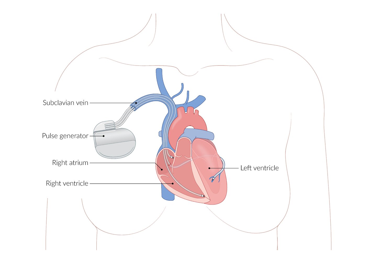 Biventricular pacemaker
