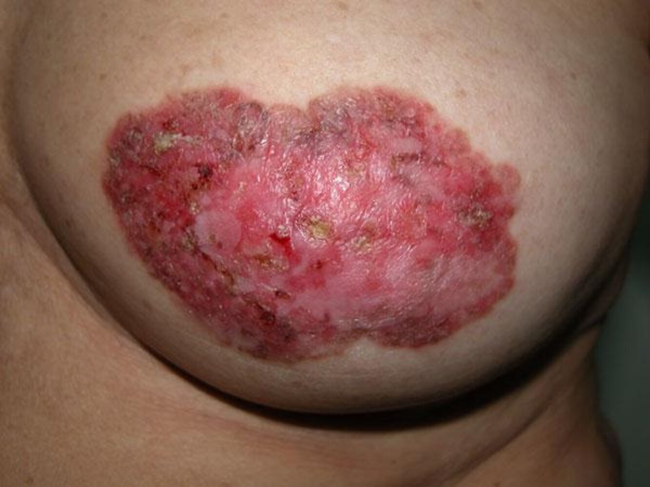 Paget disease of the breast