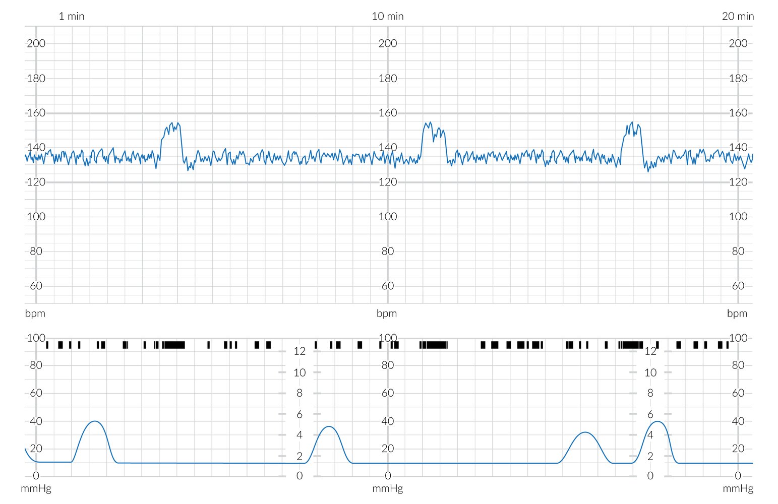 Cardiotocogram (CTG) with normal findings