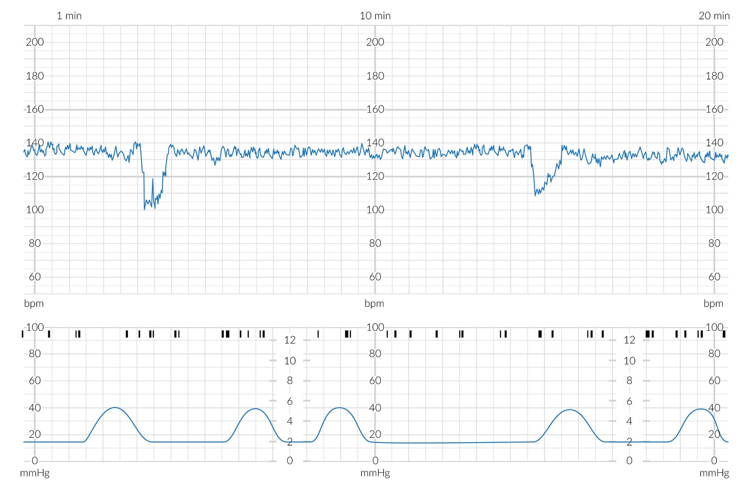 Cardiotocogram (CTG) showing intermittent variable decelerations