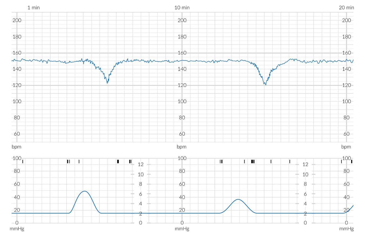 Cardiotocogram (CTG) showing late decelerations