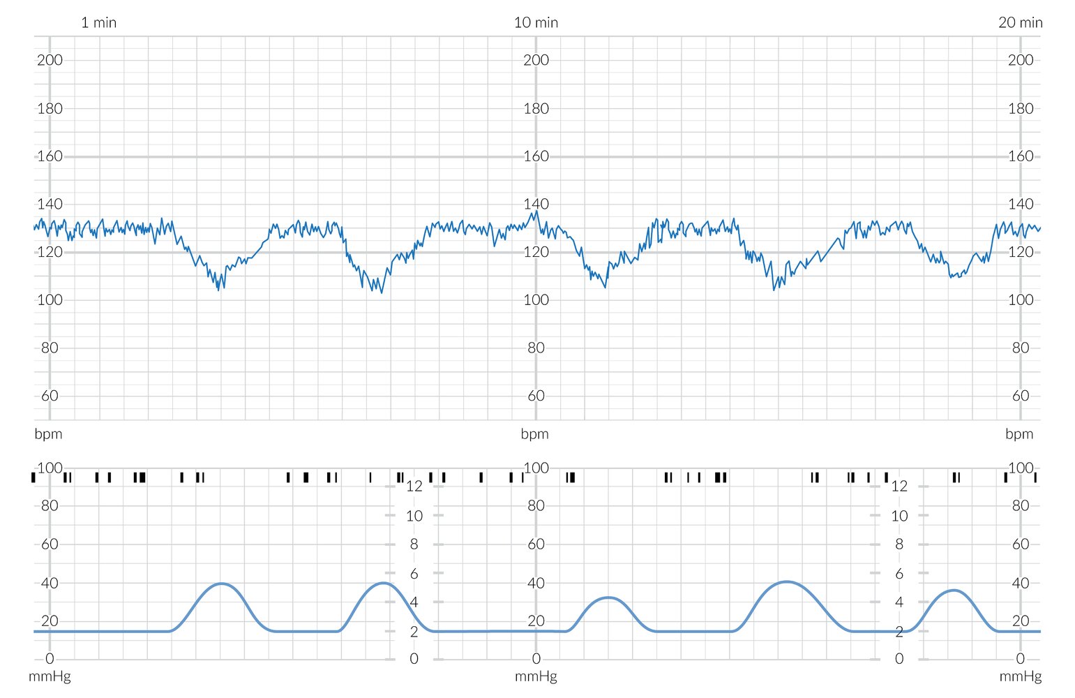 Cardiotocogram (CTG) showing early decelerations