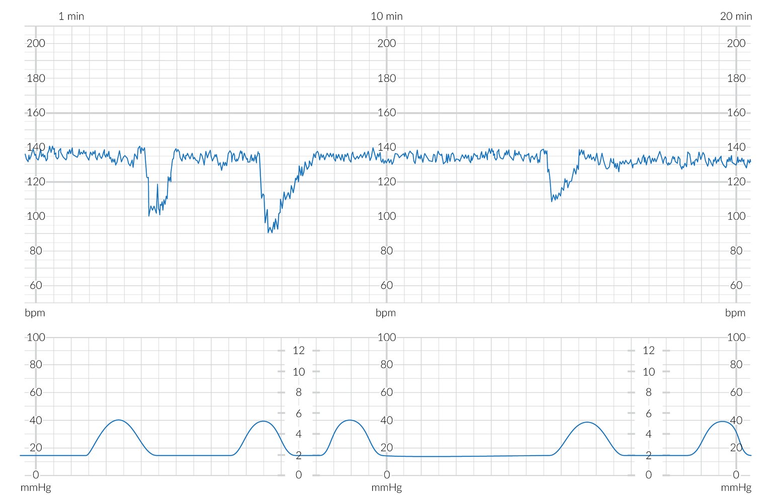 Cardiotocogram (CTG) showing recurrent variable decelerations