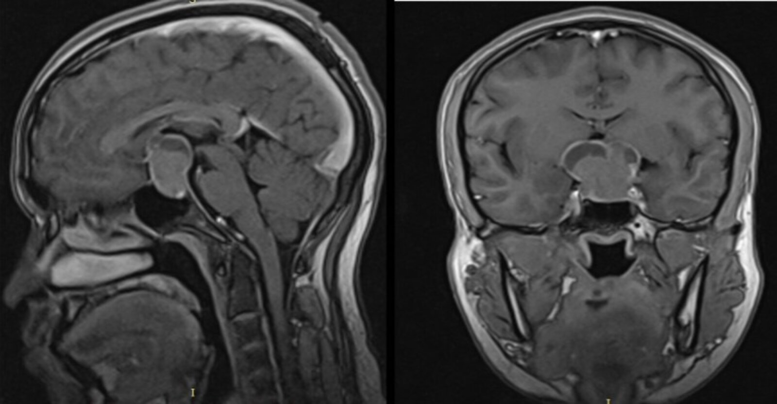 Sellar mass with suprasellar extension