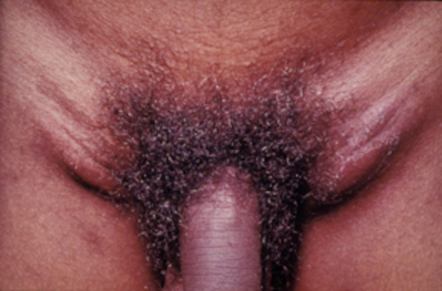 Lymphogranuloma venereum