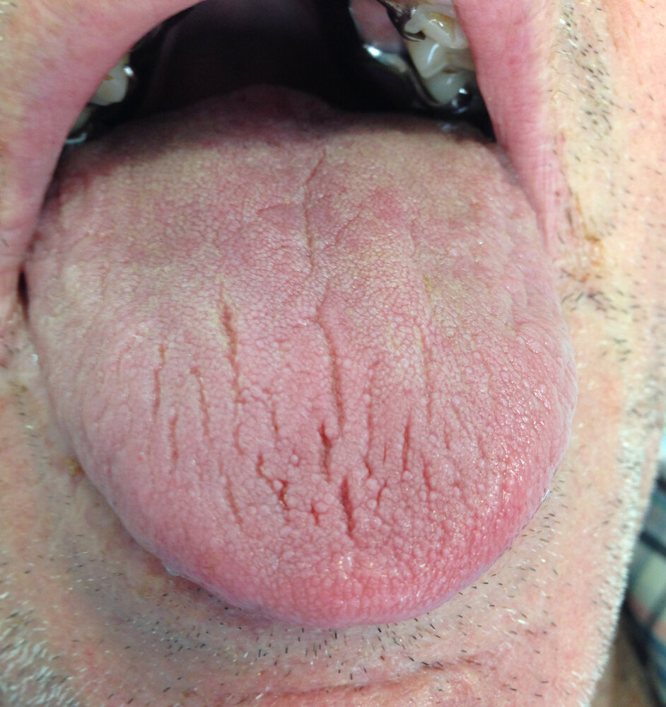Tongue furrows