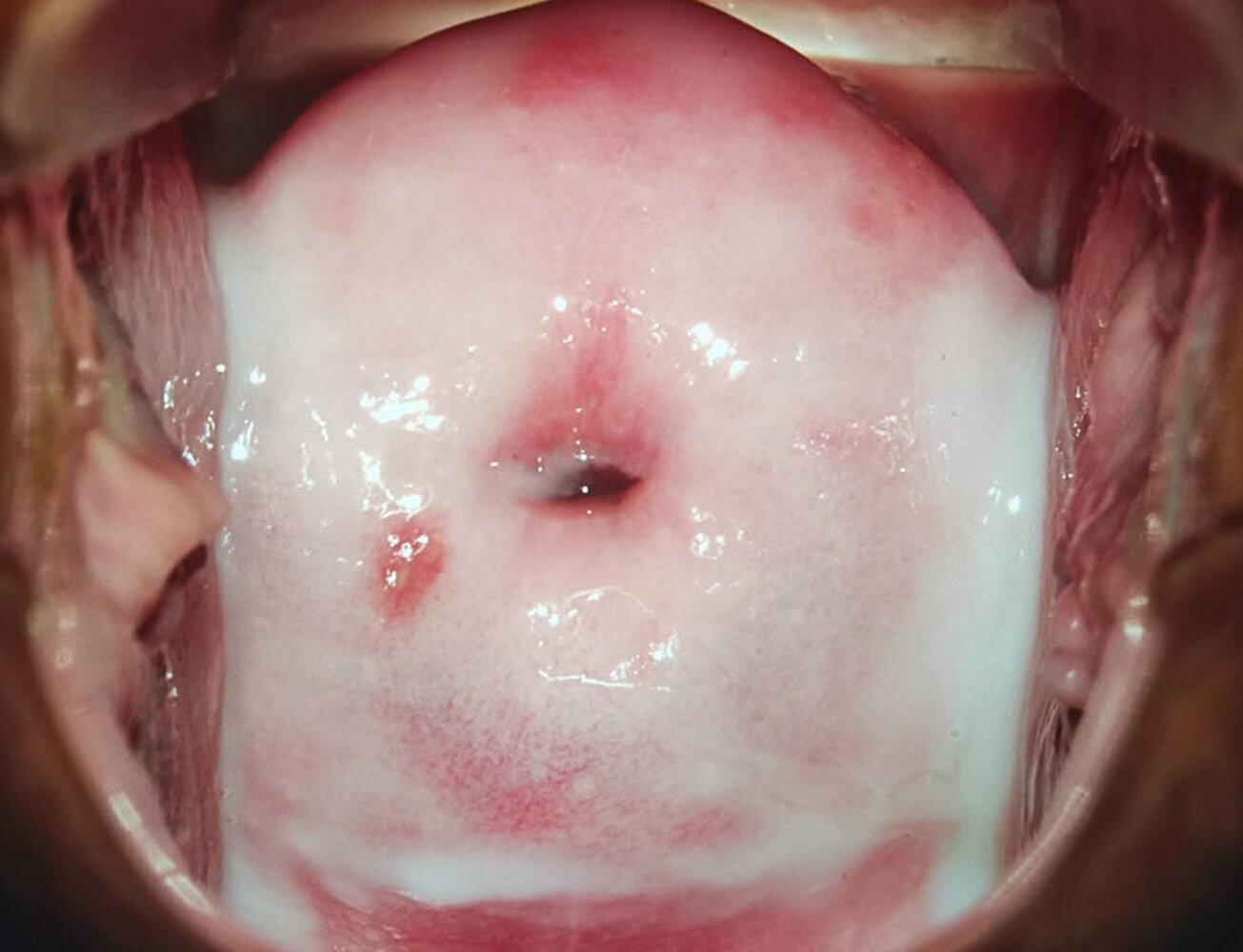 Vaginal discharge in bacterial vaginosis