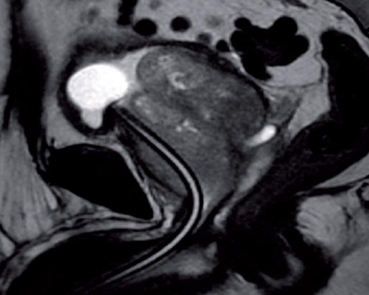 Enlarged prostate gland
