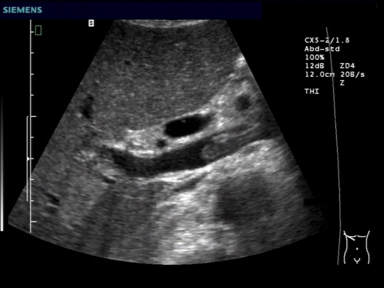 Portal vein thrombus