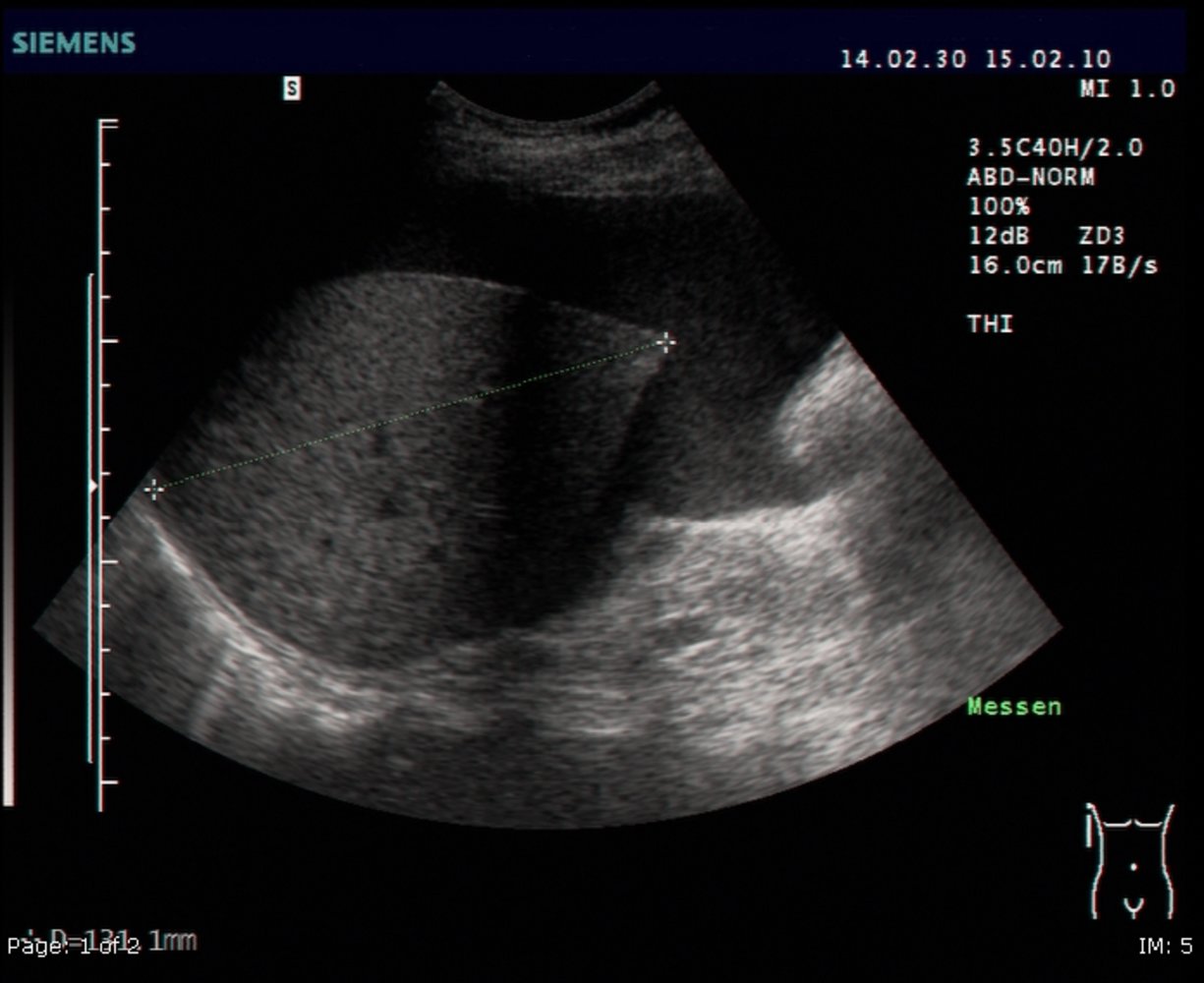 Ascites
