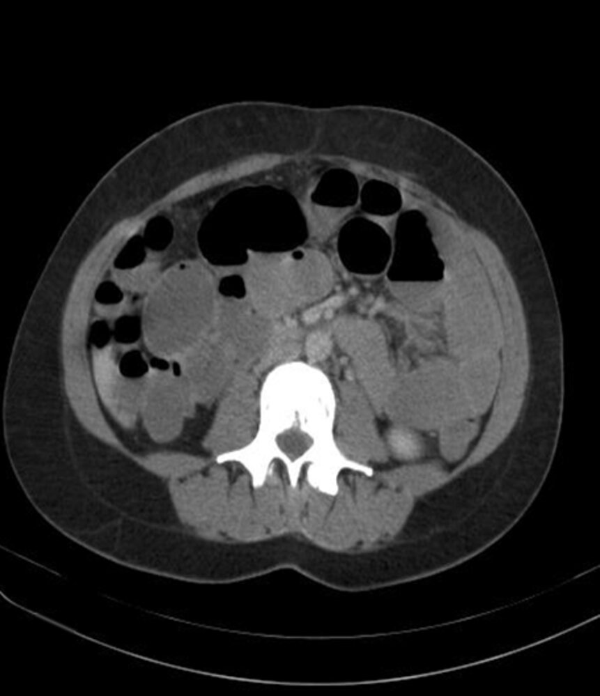 Dilated small bowel