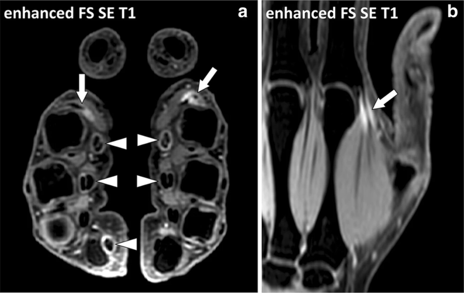 MRI of hand in rheumatoid arthritis