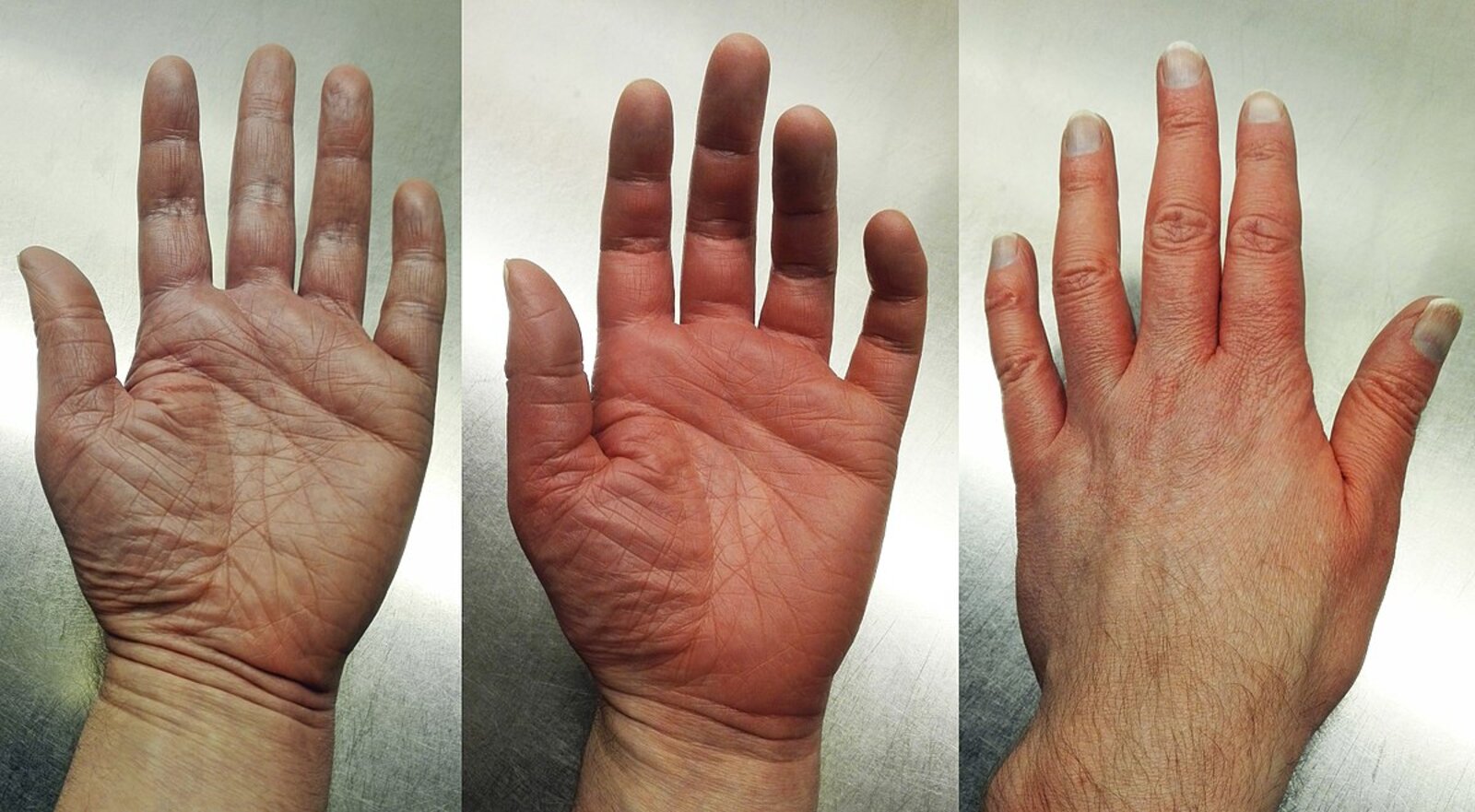 Erythromelalgia in hereditary small fiber neuropathy