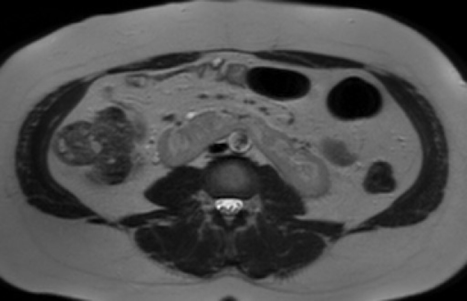 Horseshoe kidney