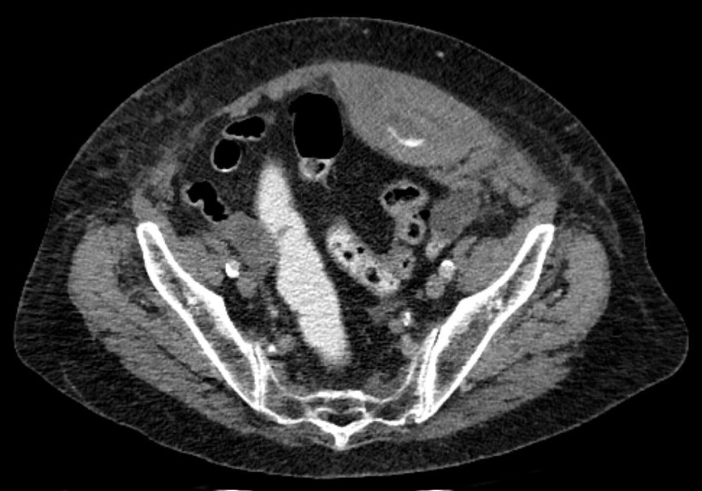 Rectus sheath hematoma