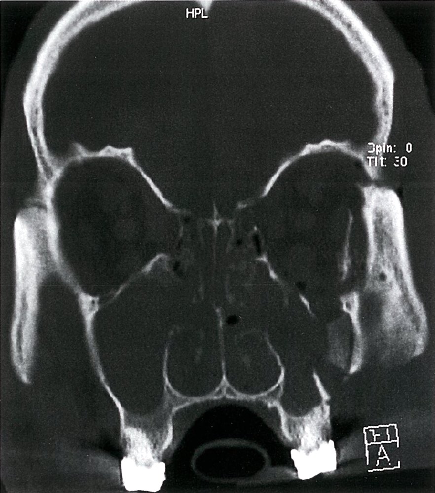 Facial and orbital fractures