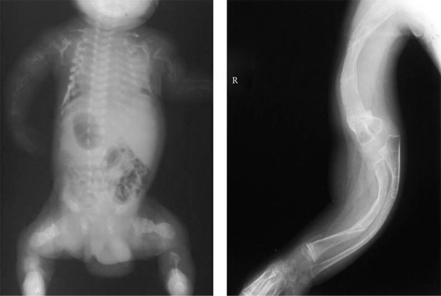 Skeletal deformities in osteogenesis imperfecta