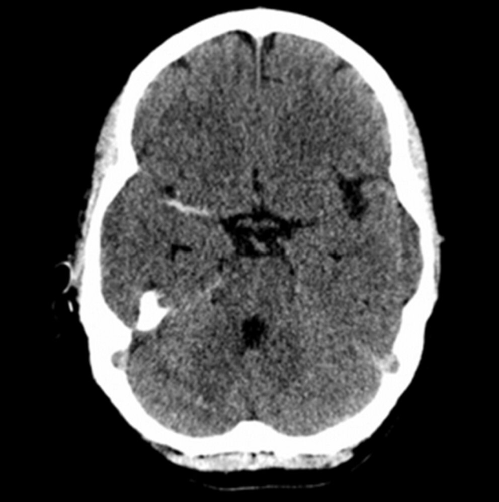 Hyperdense middle cerebral artery (MCA) sign