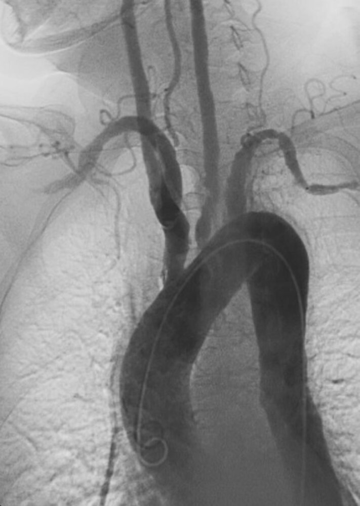 Great vessel stenoses