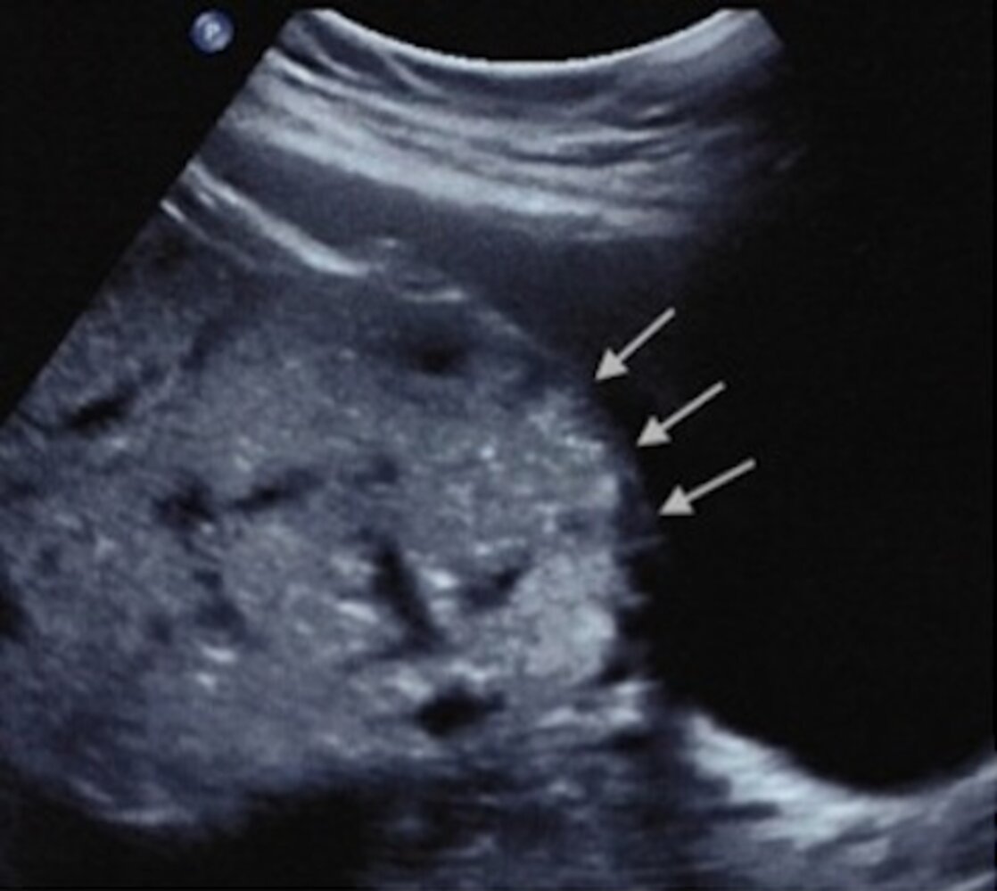 Uterine-bladder interface in placenta accreta