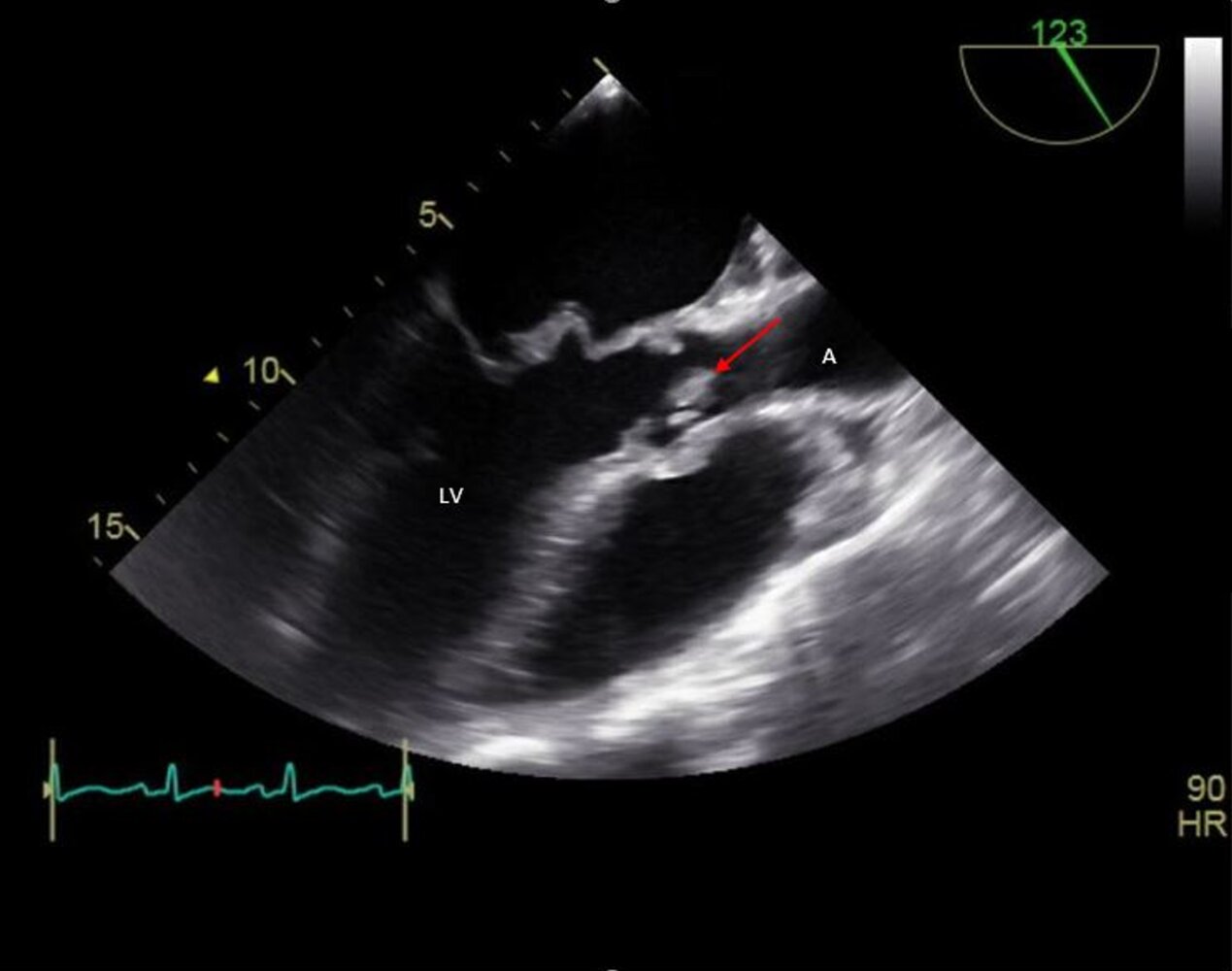 Aortic valve vegetation