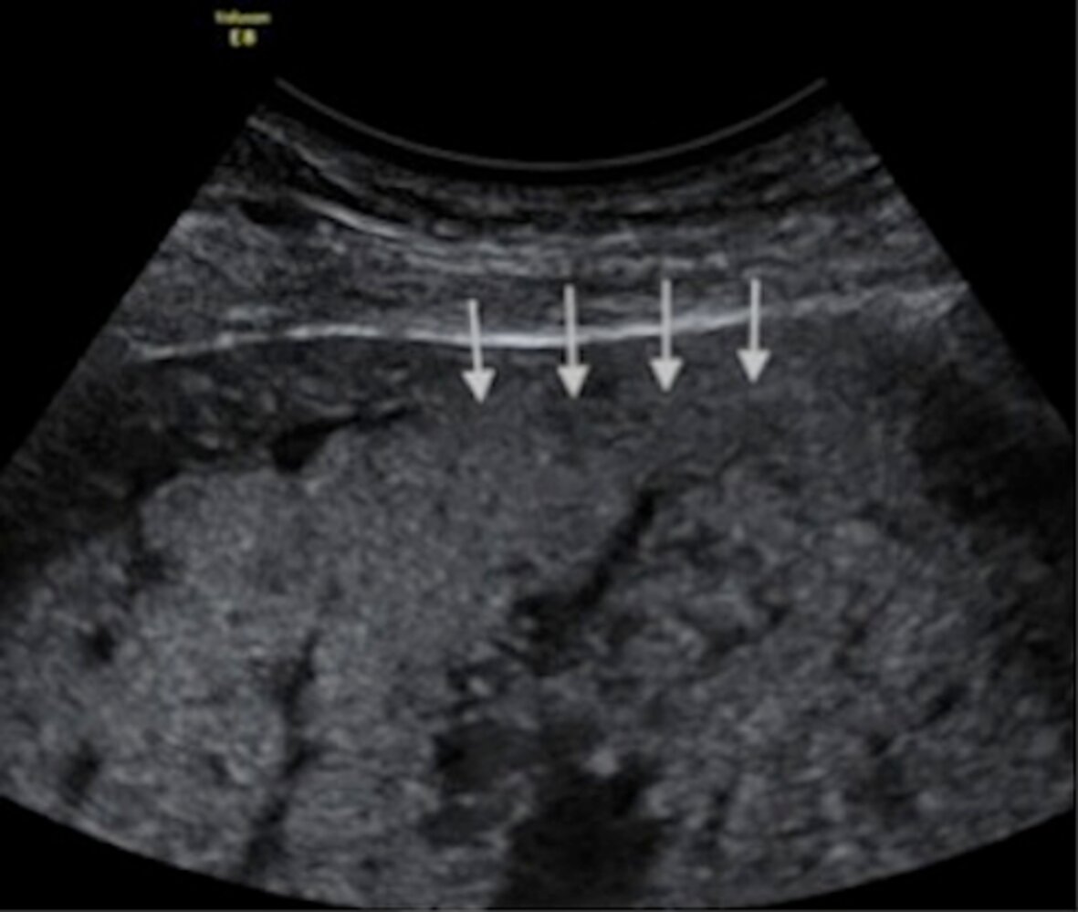 Loss of retroplacental clear zone in placenta accreta