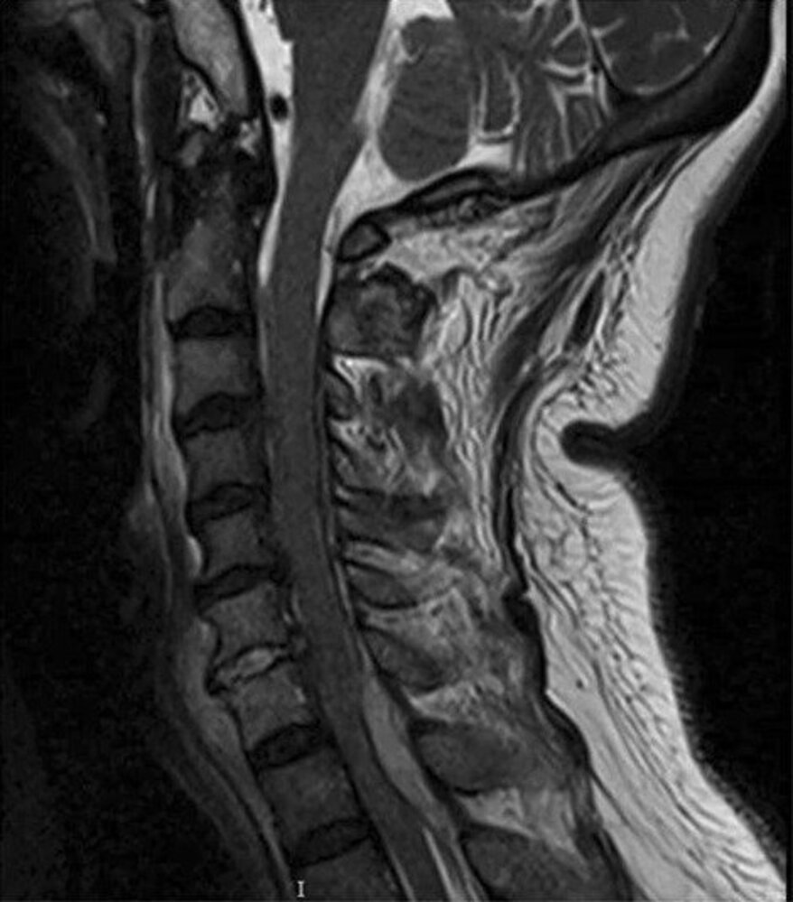 Spinal epidural abscess, osteomyelitis, and discitis