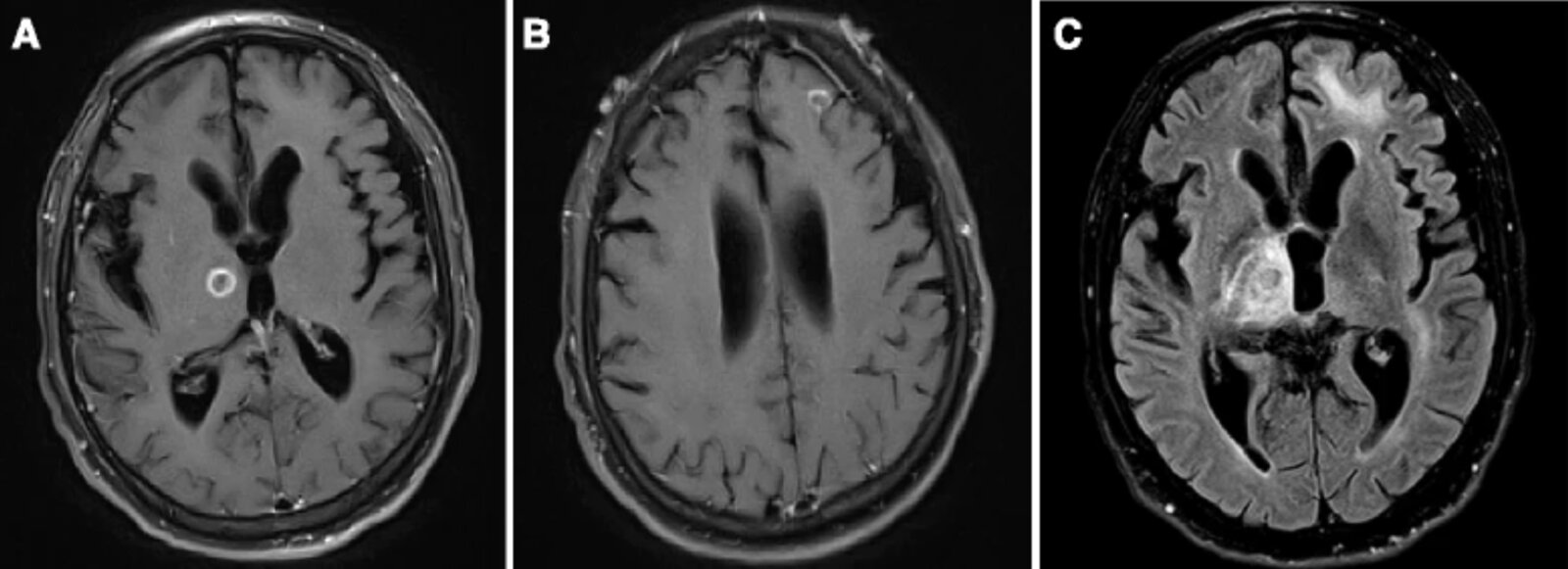 Ring-enhancing lesions in the brain