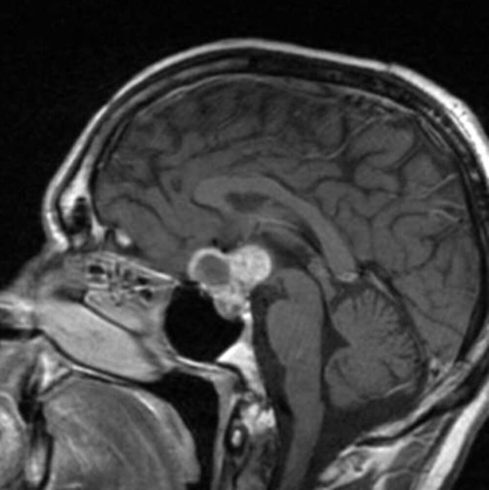 Craniopharyngioma