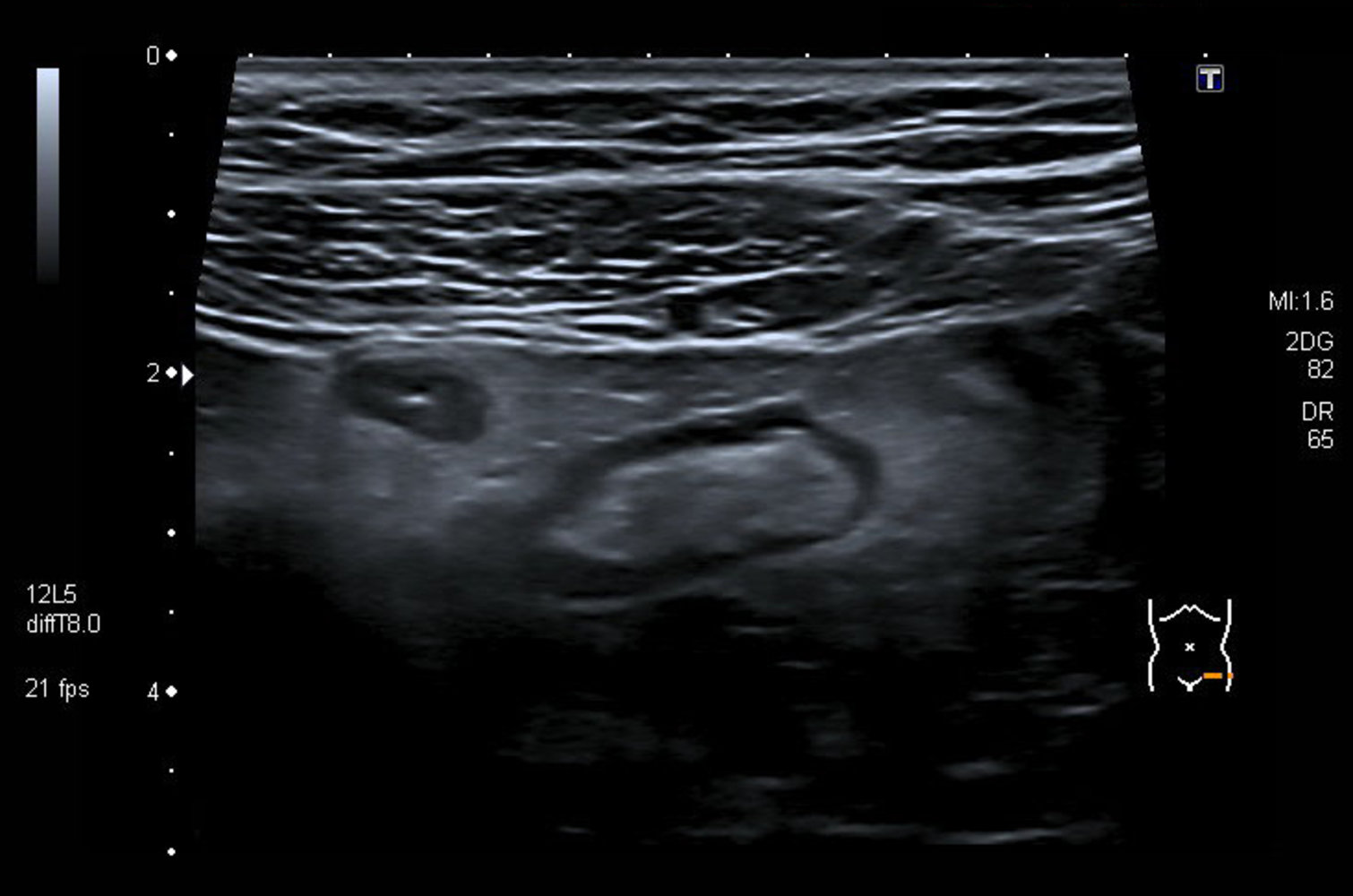 Diverticulitis