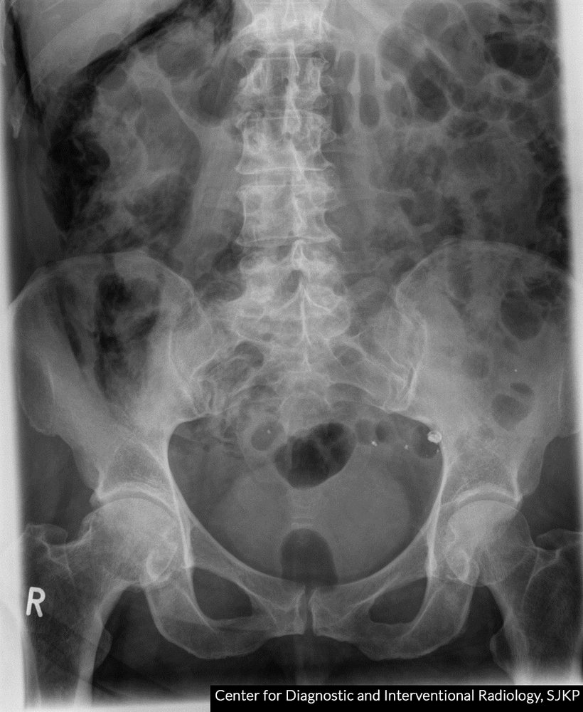 Pneumoretroperitoneum and pneumoperitoneum