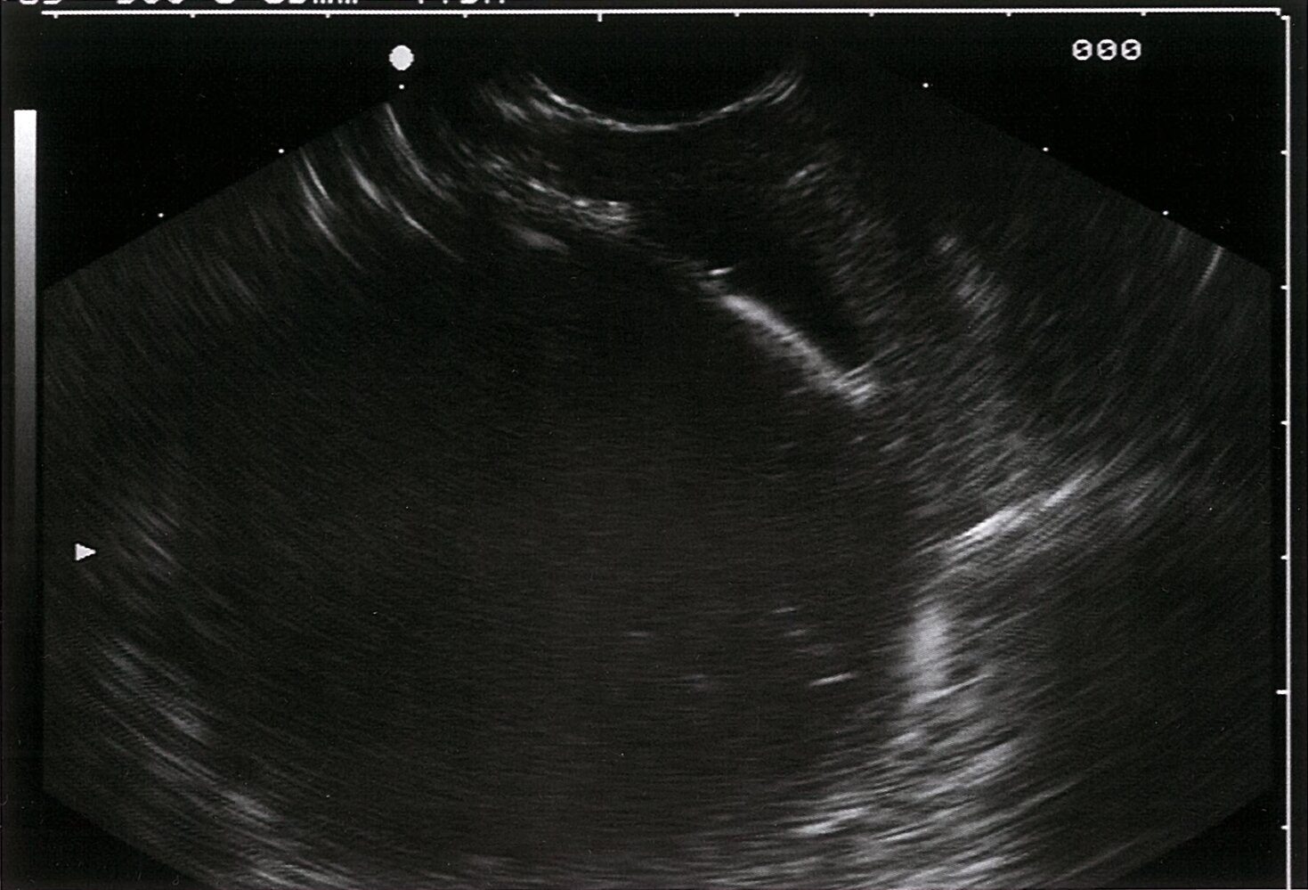 Pancreatic pseudocyst