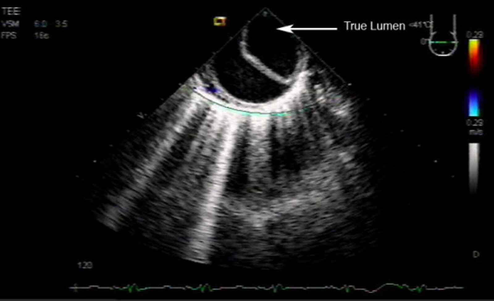 Transesophageal echocardiography of aortic dissection
