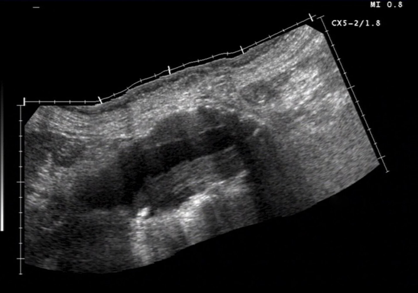 Aortic abdominal aneurysm with mural thrombus