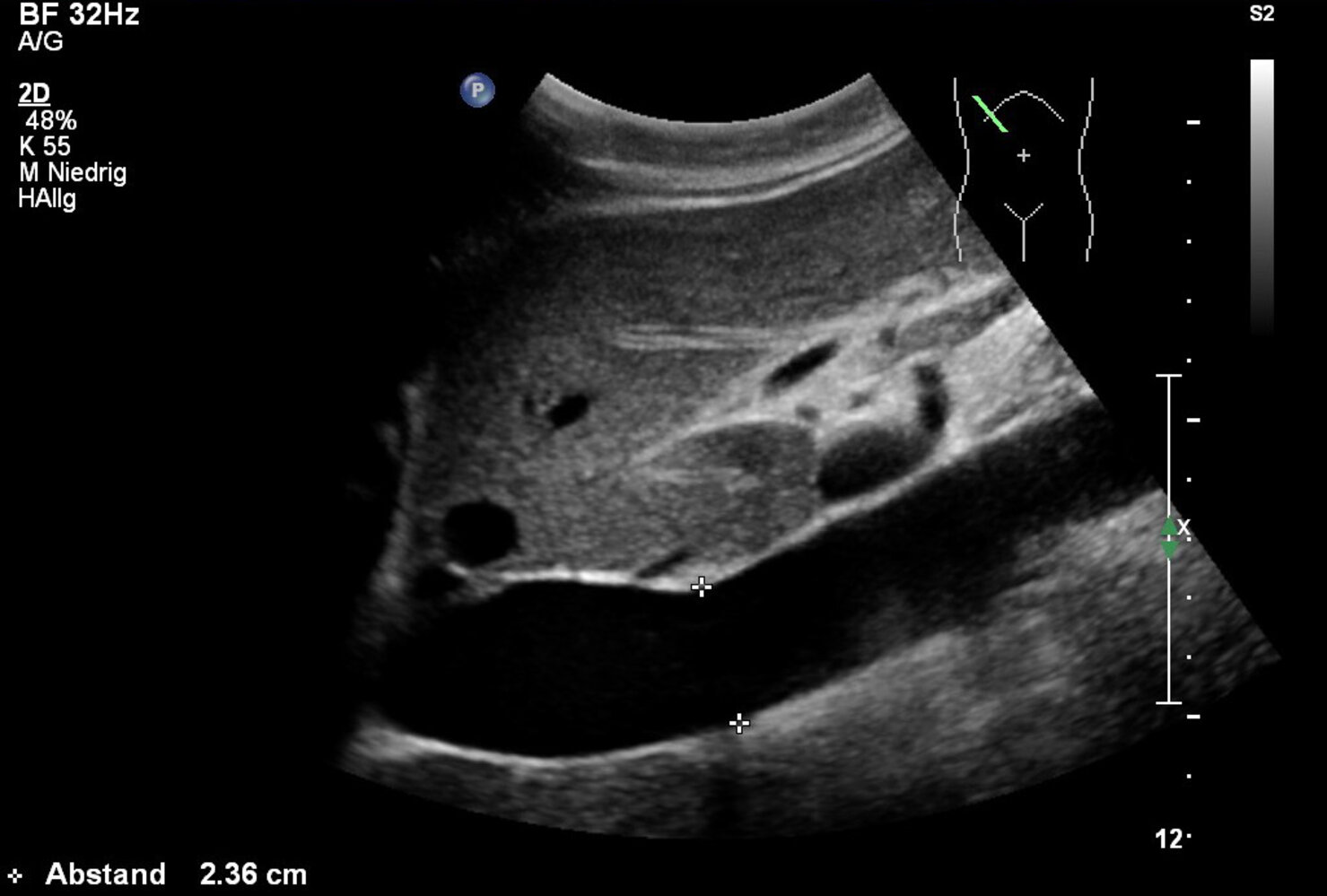 Dilated inferior vena cava