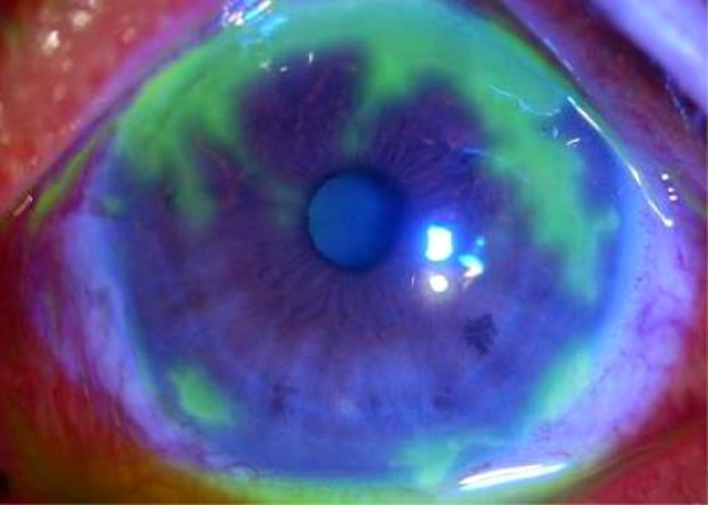 Herpes simplex keratitis